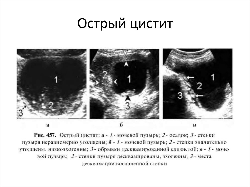 Цистит на фоне зачатия