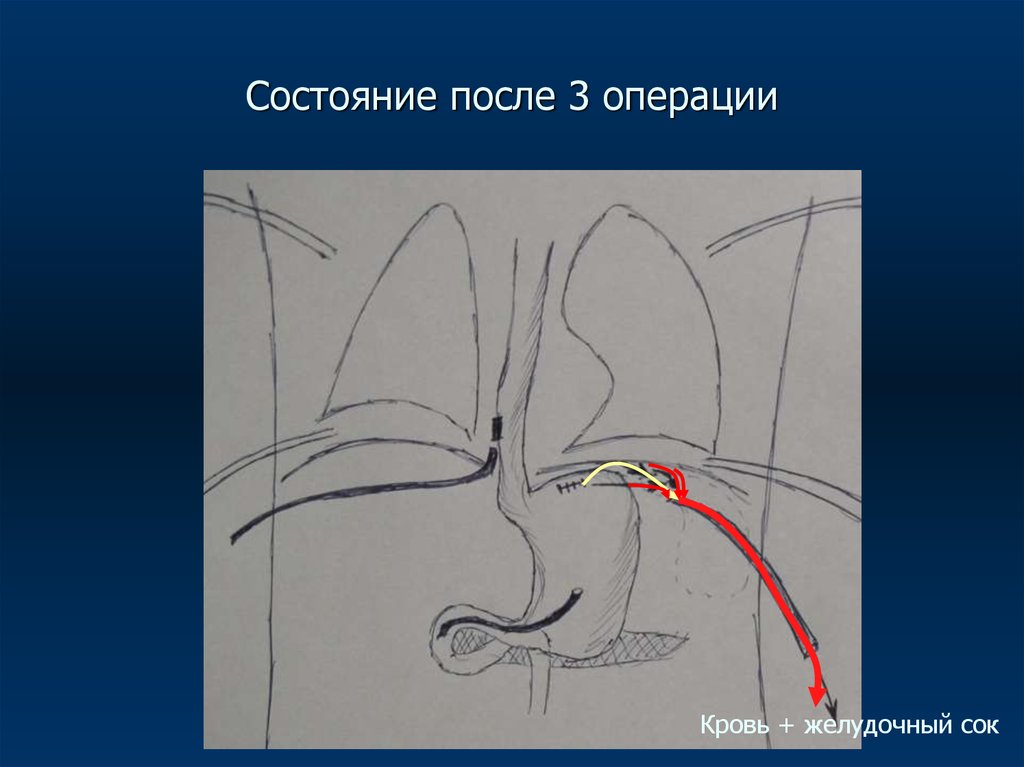 операция по удалению желчного. лапароскопия аппендэктомия. операция три точки. три точки. аппендэктомия разрез волковича-дьяконова.