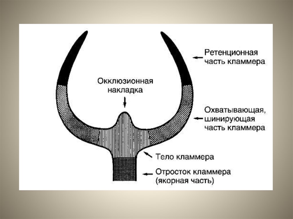 Окклюзионная накладка бюгельного протеза. Части кламмера тело плечо отросток. Составные части кламмера. Ретенционная зона кламмера. Кламмера Аккера.