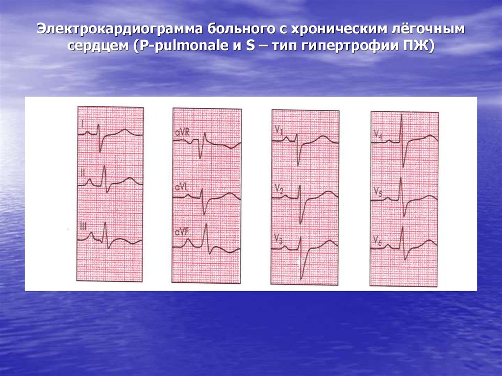 Типы экг. Хроническое легочное сердце ЭКГ. ЭКГ при легочном сердце. S Тип ЭКГ. S-Тип электрокардиограммы.