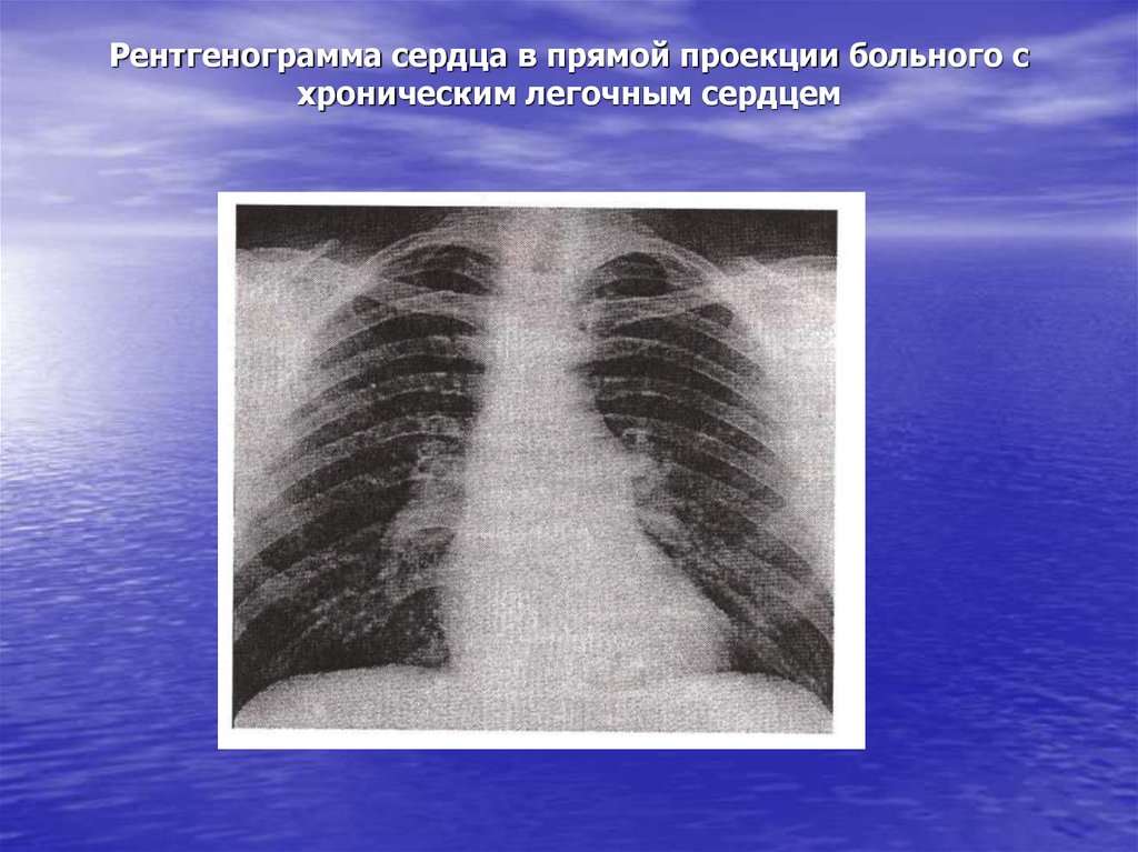 Рентгенография в прямой проекции. Хроническое легочное сердце рентгенограмма. Хроническое легочное сердце рентген. Легочное сердце на рентгенограмме.