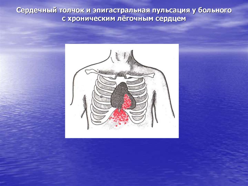 Сердечный толчок. Сердечный толчок и эпигастральная пульсация. Сердечный толчок сердца. Верхушечный толчок сердечный толчок эпигастральная. Оценка эпигастральной пульсации.