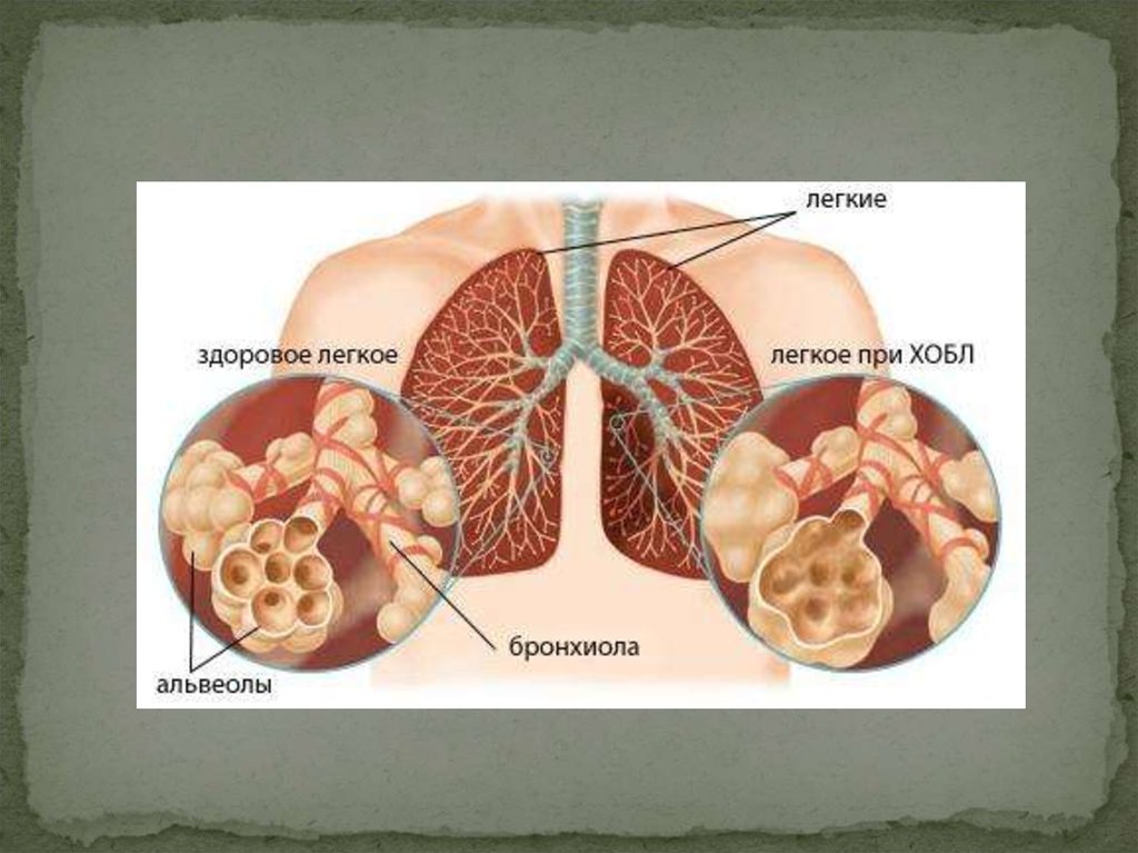 Хроническая обструктивная болезнь легких картинки