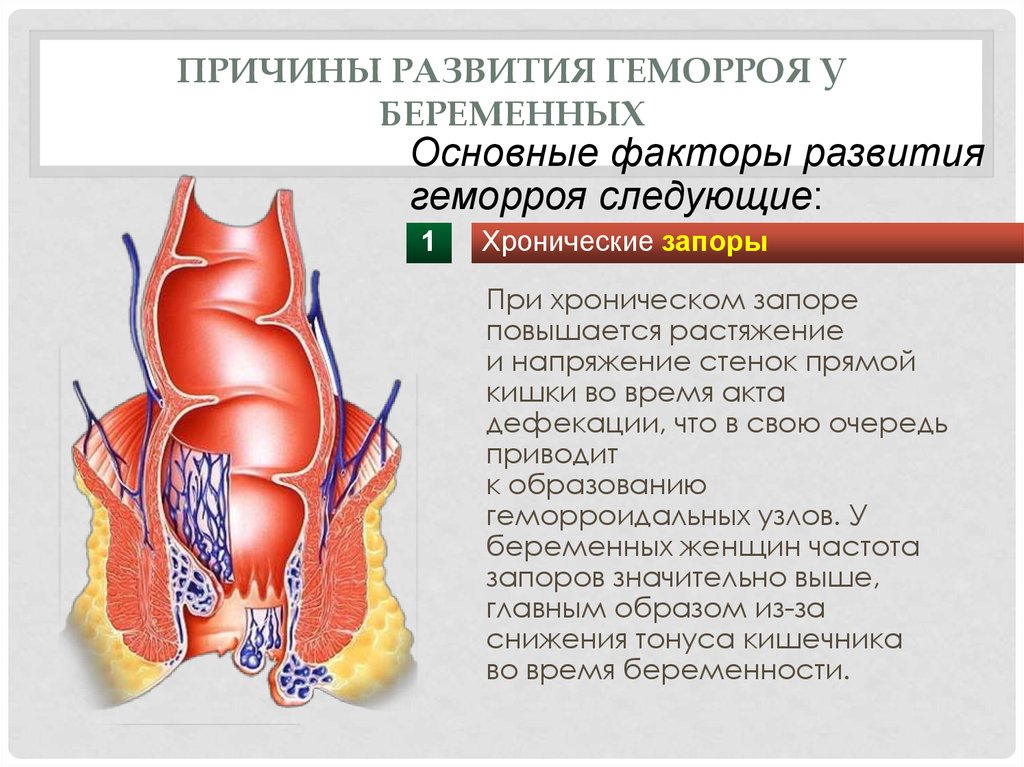 Выпадение прямой кишки при дефекации. Гемморойпри беременности. Геморрой при беременности. Начальная стадия геморроя.