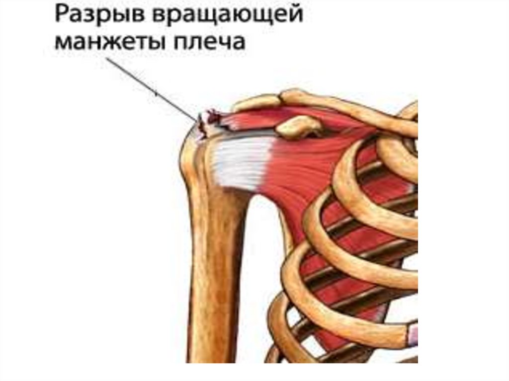 Разрыв манжеты плечевого. Мышцы ротаторной манжеты плечевого сустава. Повреждение ротаторная манжета. Ротаторная манжета плечевого сустава разрыв. Ротаторная манжета плечевого сустава анатомия.