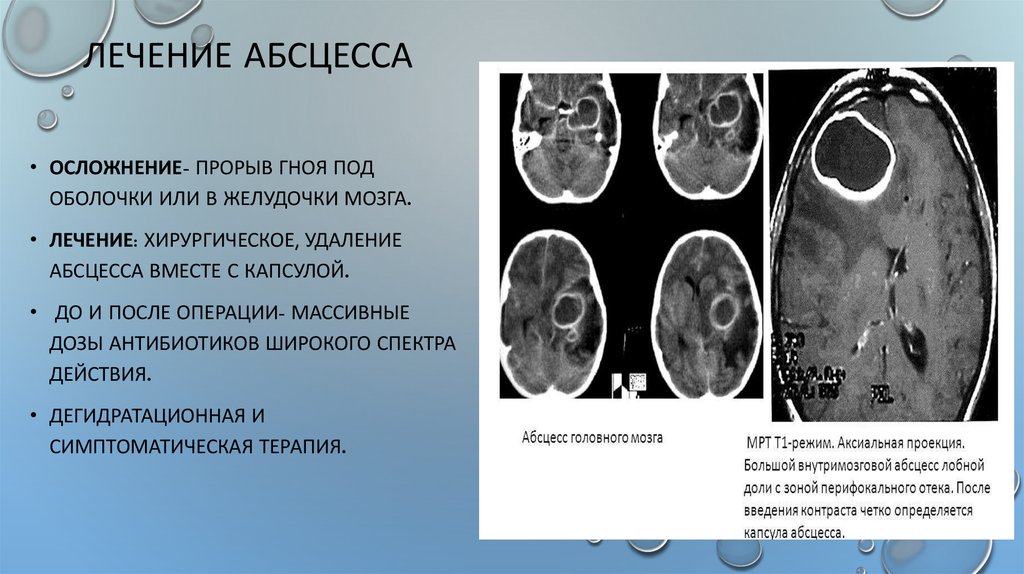 Осложнения после резекции