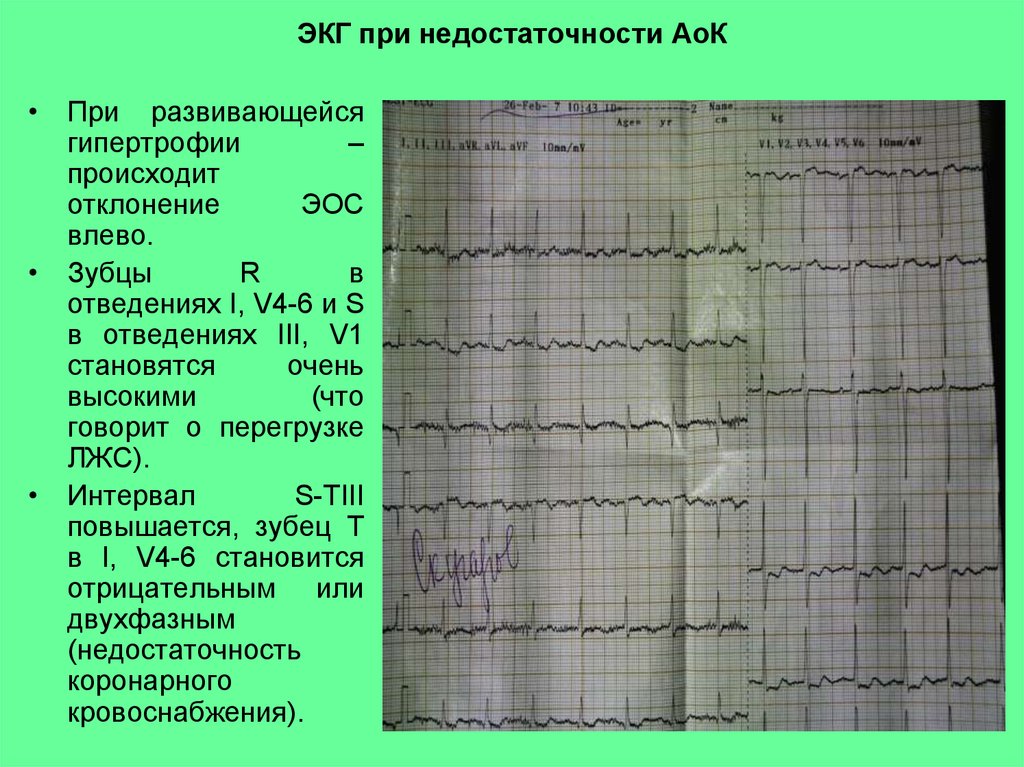 Отклонения на экг. Отклонение ЭОС влево на ЭКГ. ЭКГ при отклонении ЭОС влево. Кардиограмма с отклонениями. ЭКГ при декстрокардии.