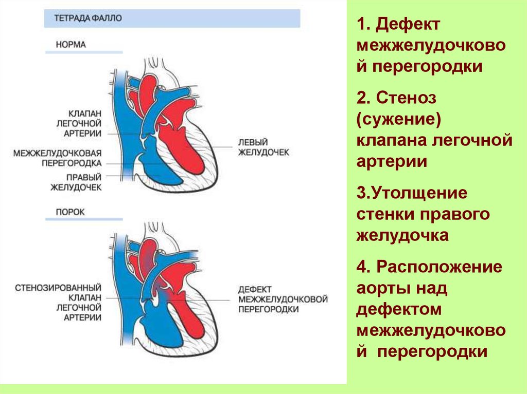 Тетрада фалло лечение