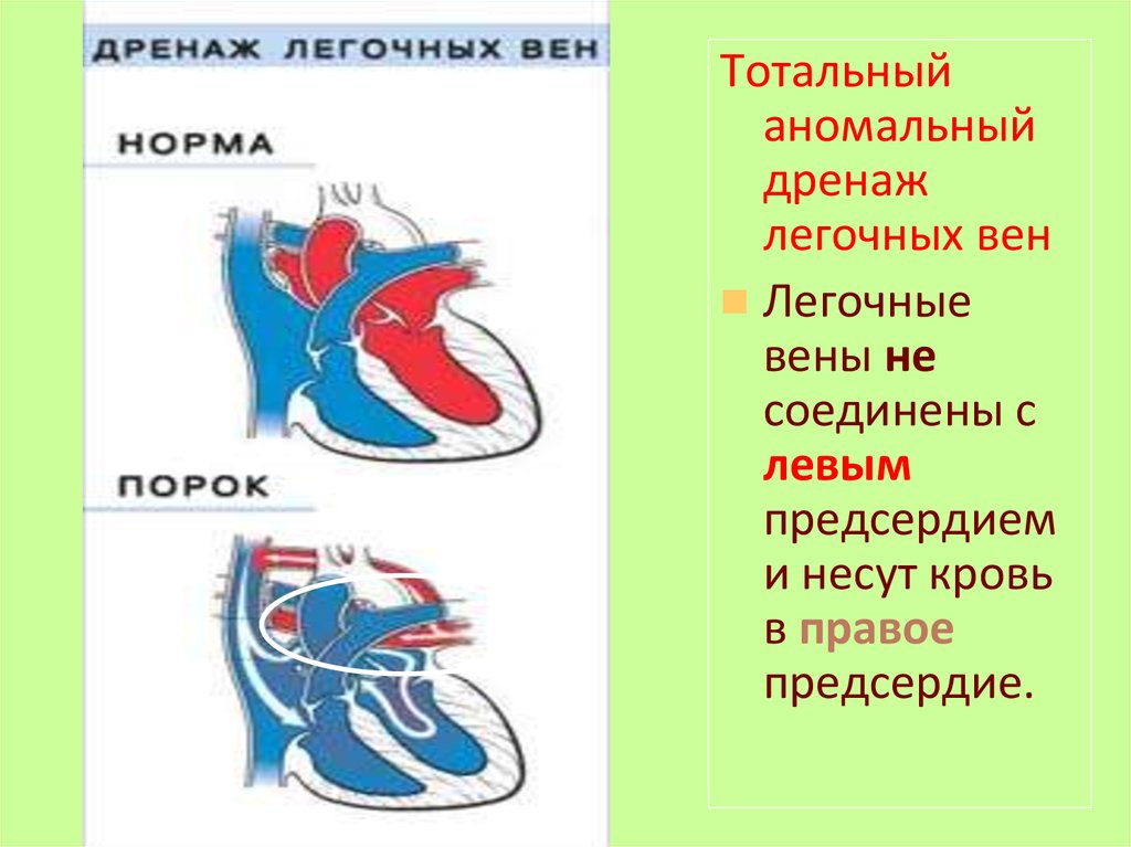 Легочных вен левое предсердие. Тотальный аномальный дренаж легочных вен. Аномальное впадение легочных вен. Частичный аномальный дренаж легочных вен. Тотальный (полный) аномальный дренаж легочных вен.