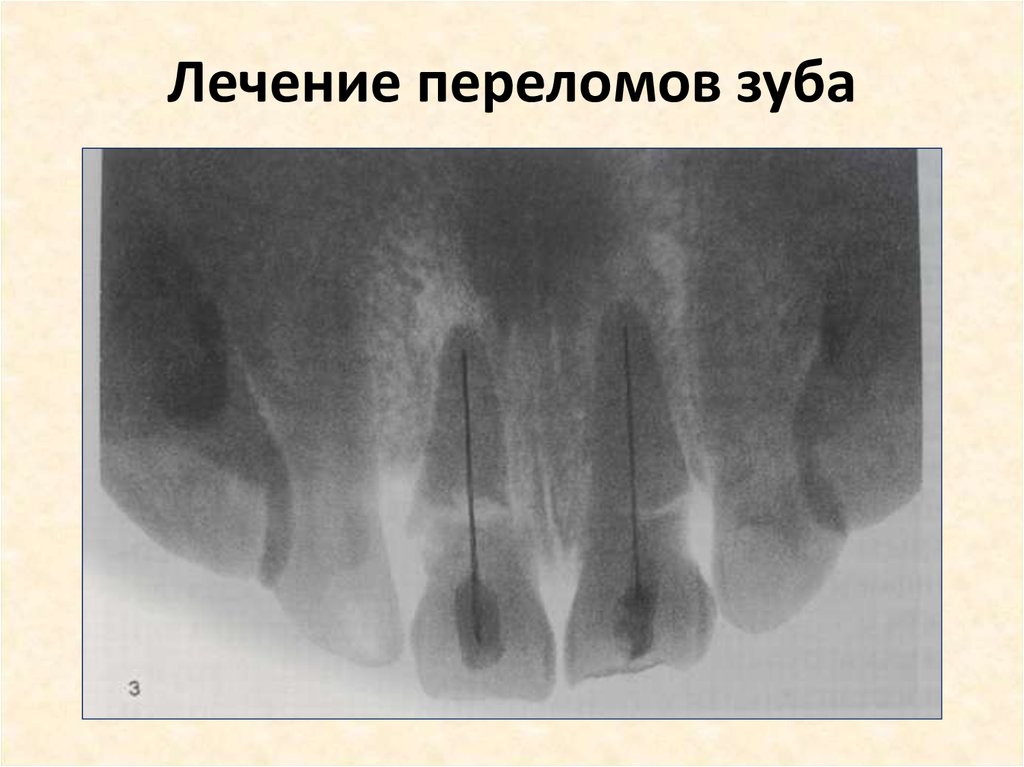 Лечение трещины форум. Коронково-корневой перелом зуба. Коронково-корневой перелом зуба рентген. Поперечный перелом зуба рентген. Перелом корня зуба рентгенограмма.