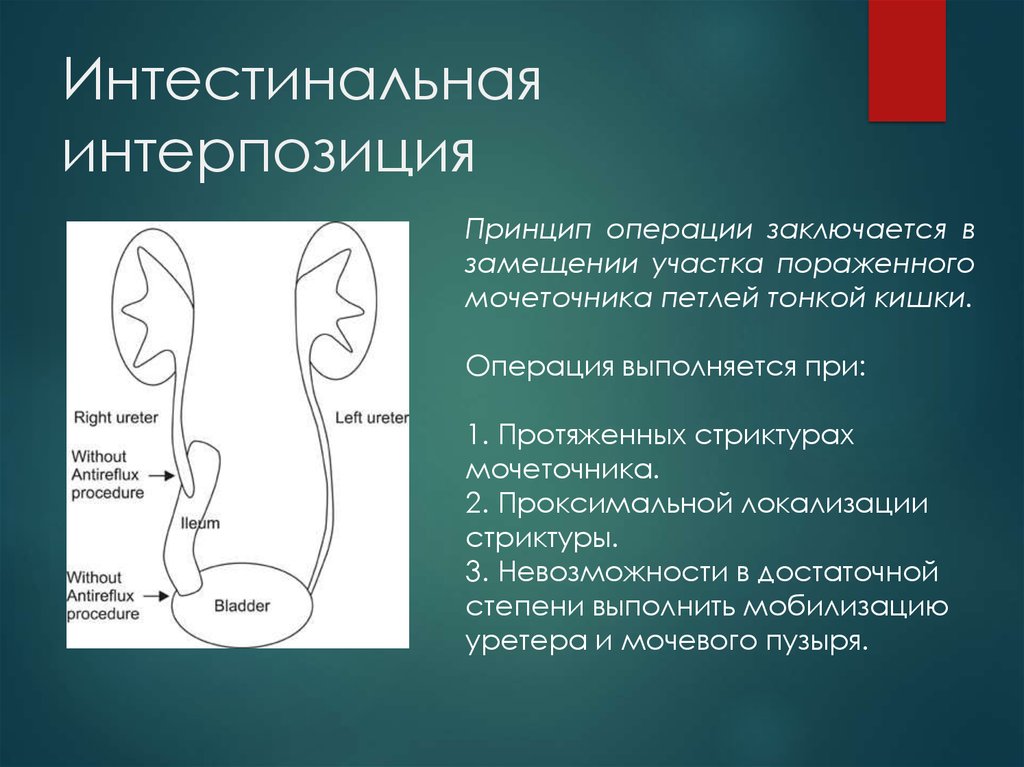 Интерпозиция это. Операция при стриктуре мочеточника. Операция по сужению мочеточника. Интестинальное Введение это. Стеноз мочеточника операция.