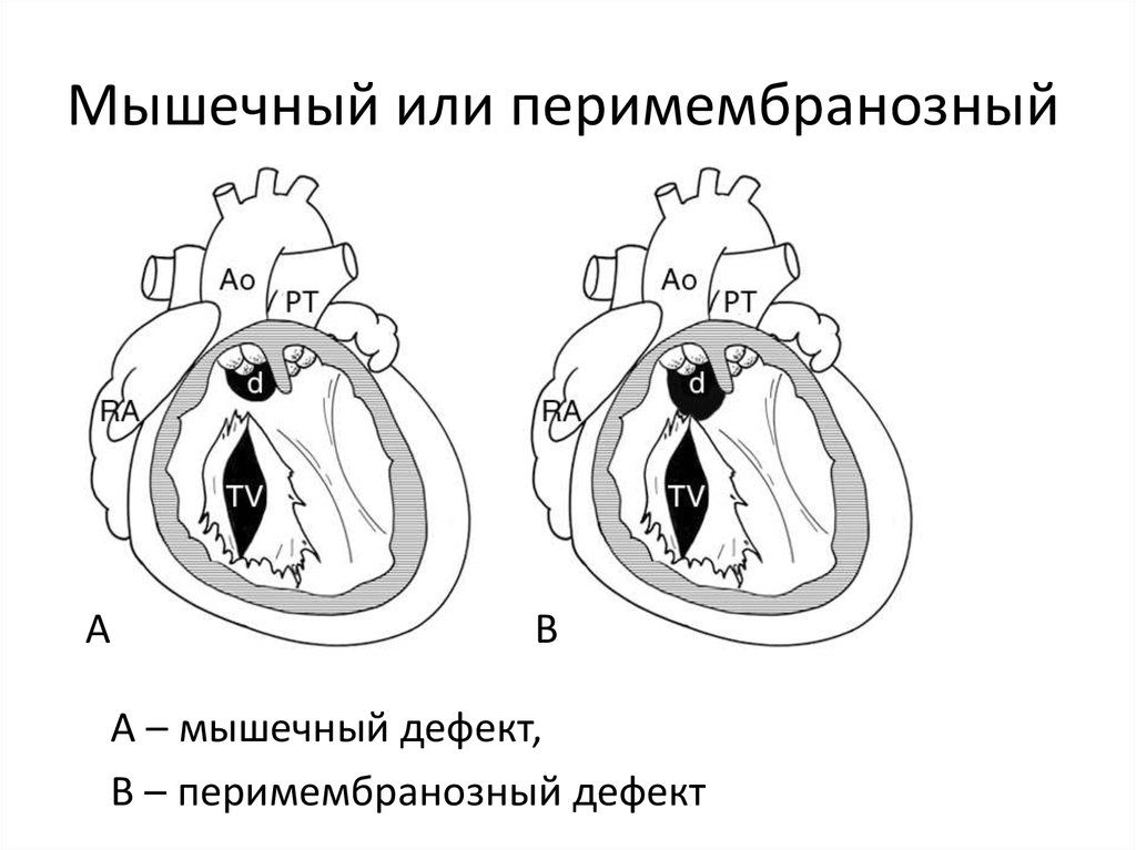 Дмжп у плода