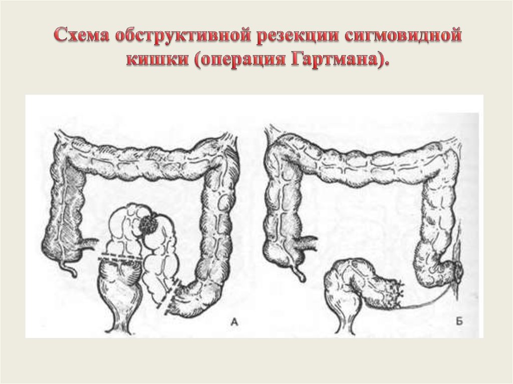 Колостома двуствольная схема