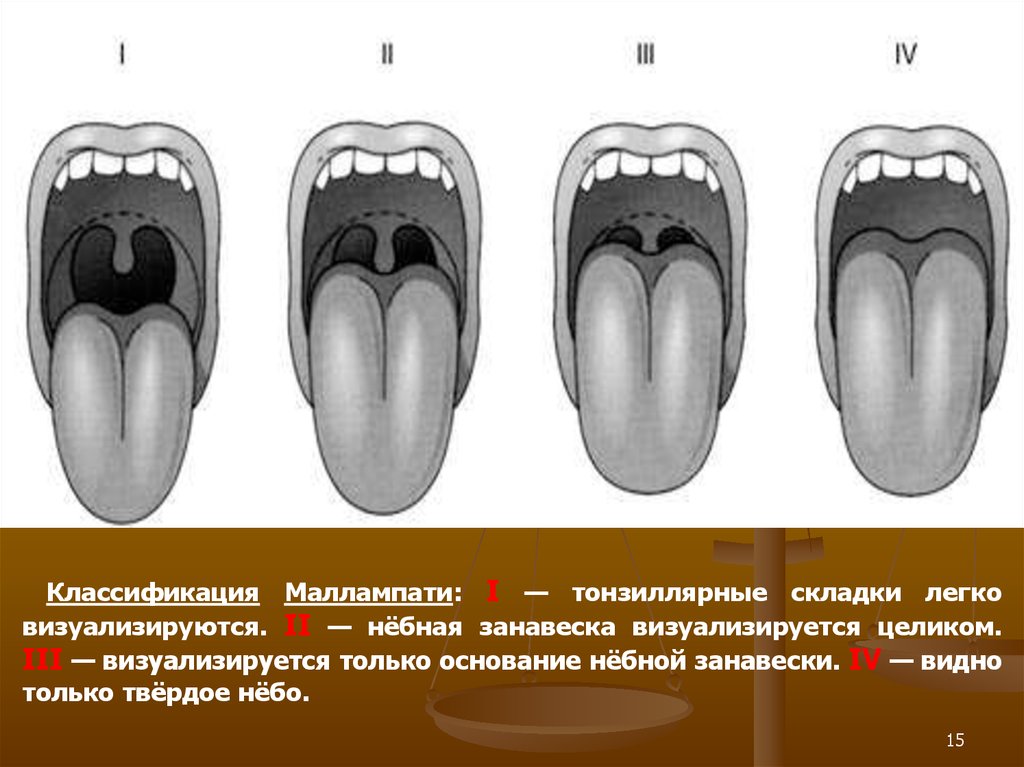 Небная занавеска. Маллампати классификация.