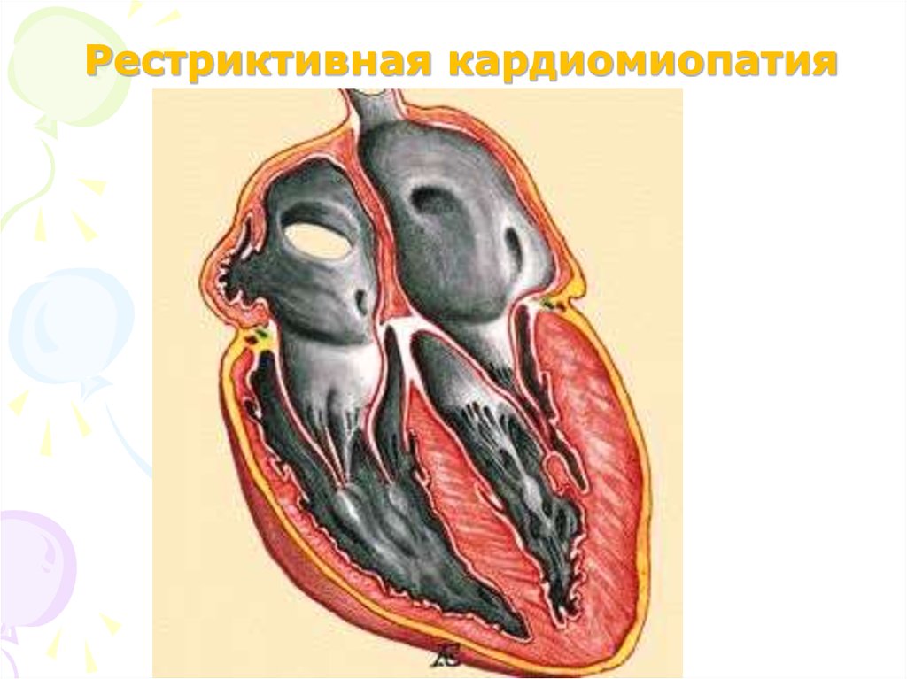 Кардиомиопатии у детей презентация