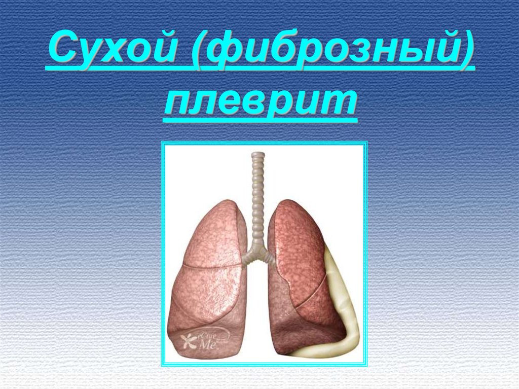 Что такое плеврит. Сухой и выпотной плеврит.