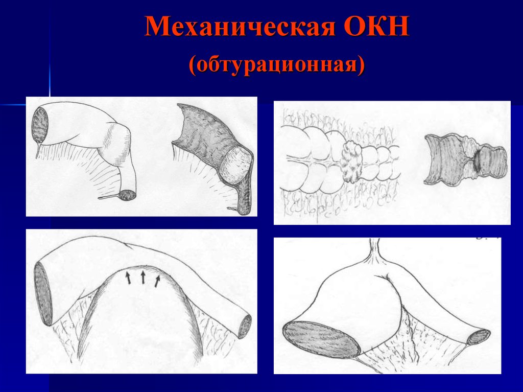 Окн это. Механическая обтурационная кишечная непроходимость. Острая обтурационная кишечная непроходимость. Острая обтурационная толстокишечная непроходимость.