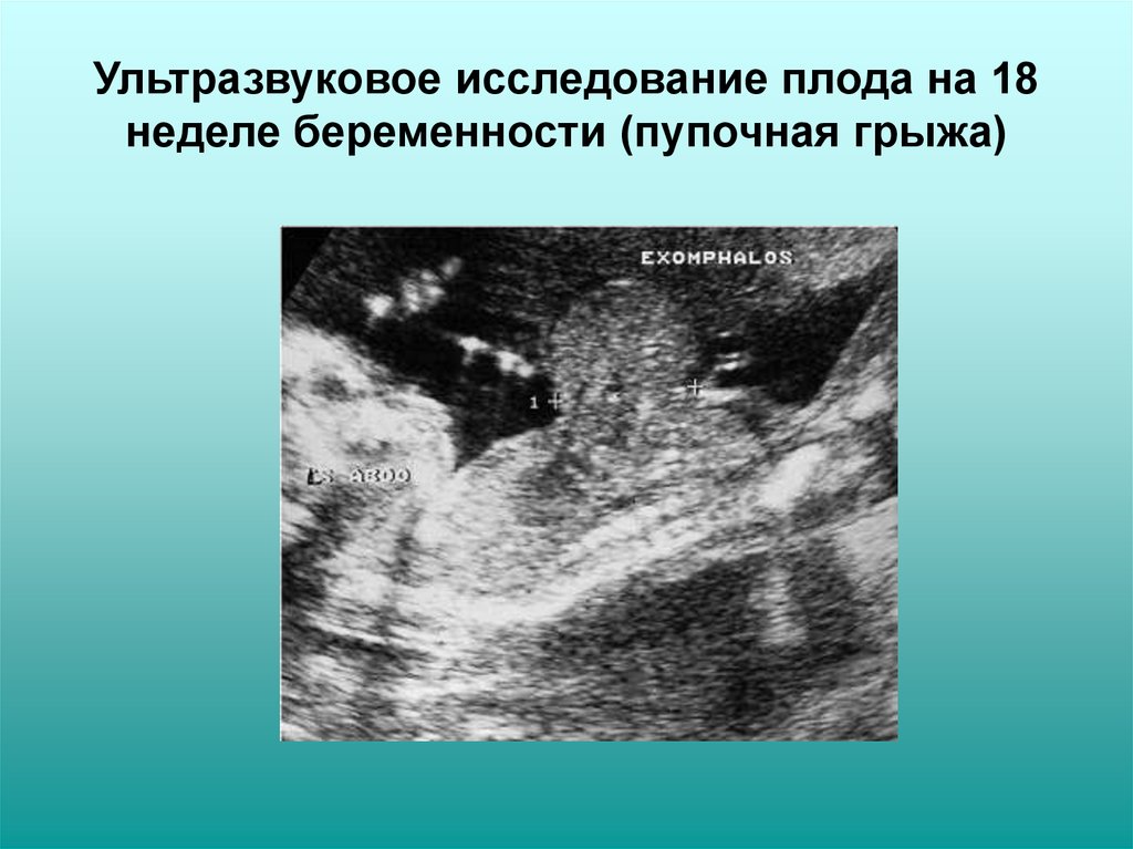 Исследование плода. Пупочная грыжа на УЗИ описание. Пупочная грыжа эмбриона на УЗИ.