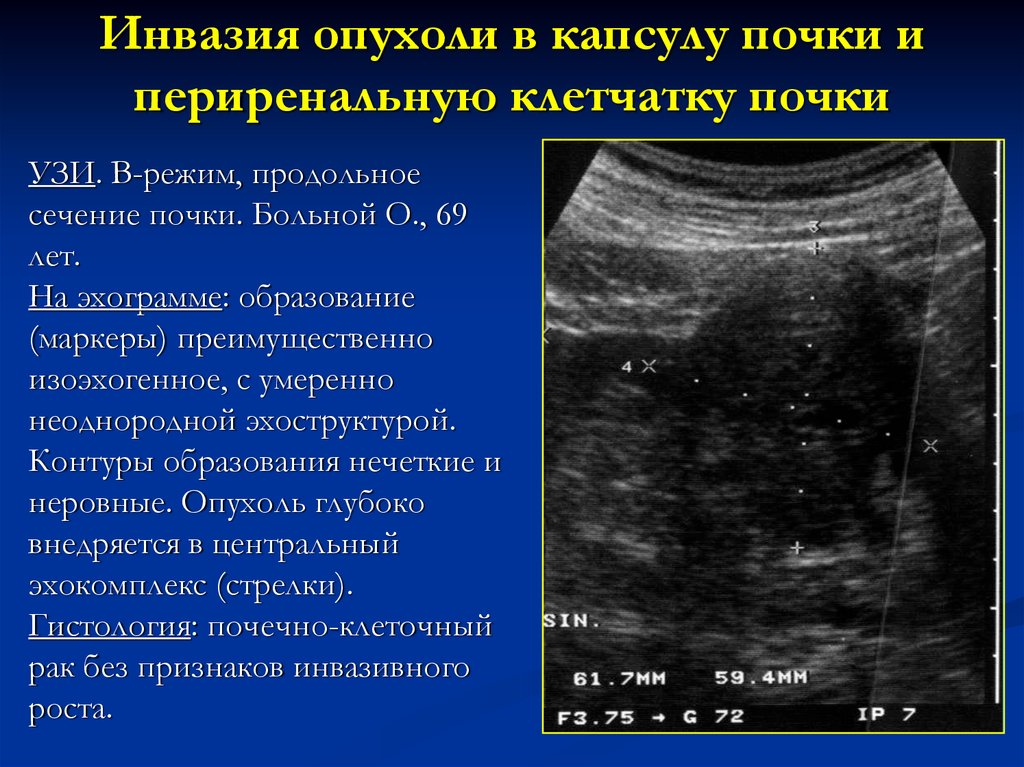 Инвазия это. Образования почек на УЗИ. Ультразвуковые признаки опухоли почки.