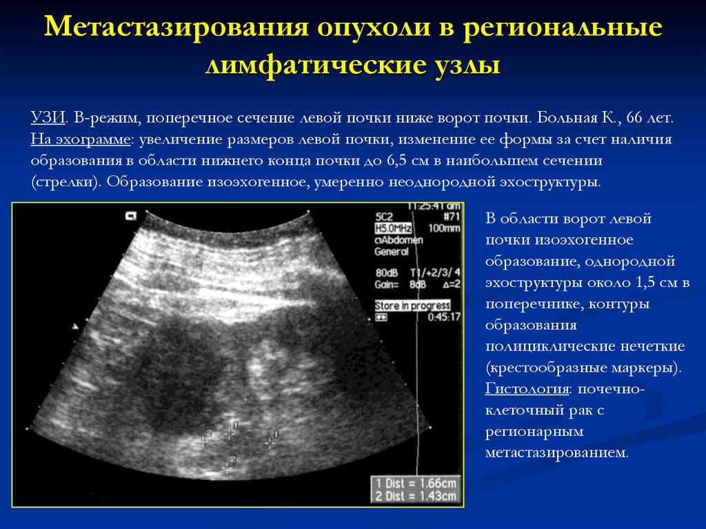 Аваскулярное образование в печени. Ультразвуковое исследование почек опухоли. Лимфатические узлы ворот печени. Лимфаденопатия ворот печени УЗИ.