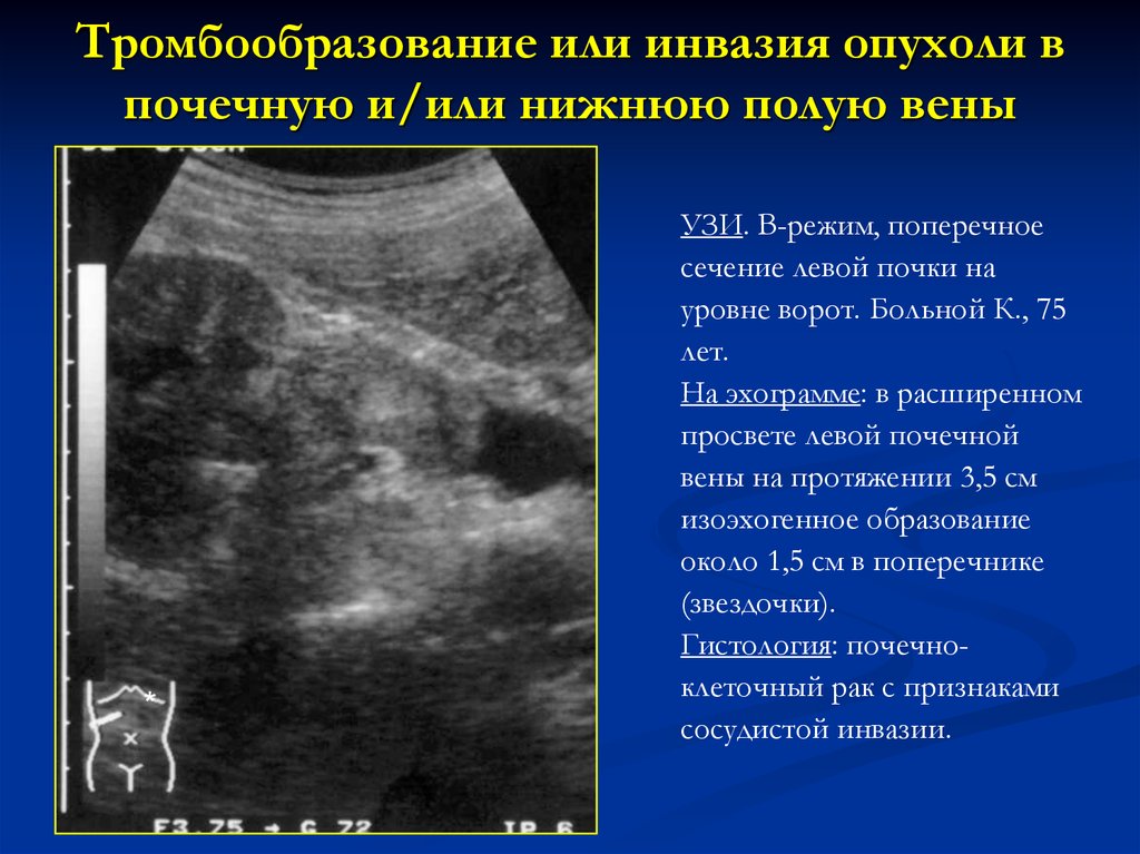 Расширение левой почки. Нижняя полая Вена диаметр норма УЗИ. Ультразвуковое исследование почек опухоли. Нижняя полая Вена норма на УЗИ.