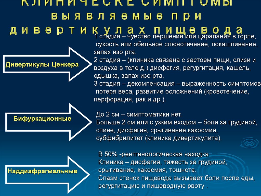 Диагностика дивертикула пищевода