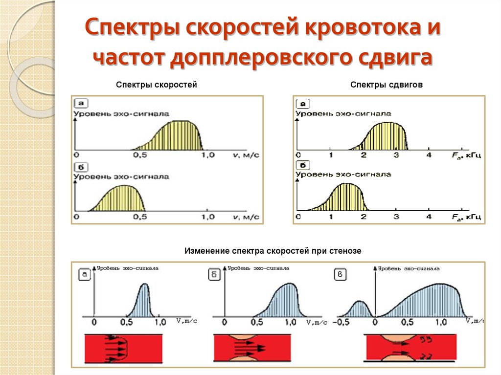 Определение скорости кровотока. Спектральная характеристика кровотока. Максимальное допплеровское смещение. Кривые скорости кровотока. При увеличении скорости кровотока доплеровский сдвиг частоты.