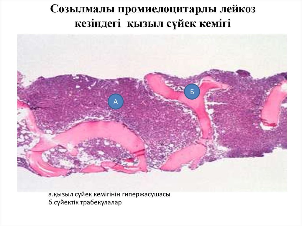 Созылмалы лимфолейкоз презентация