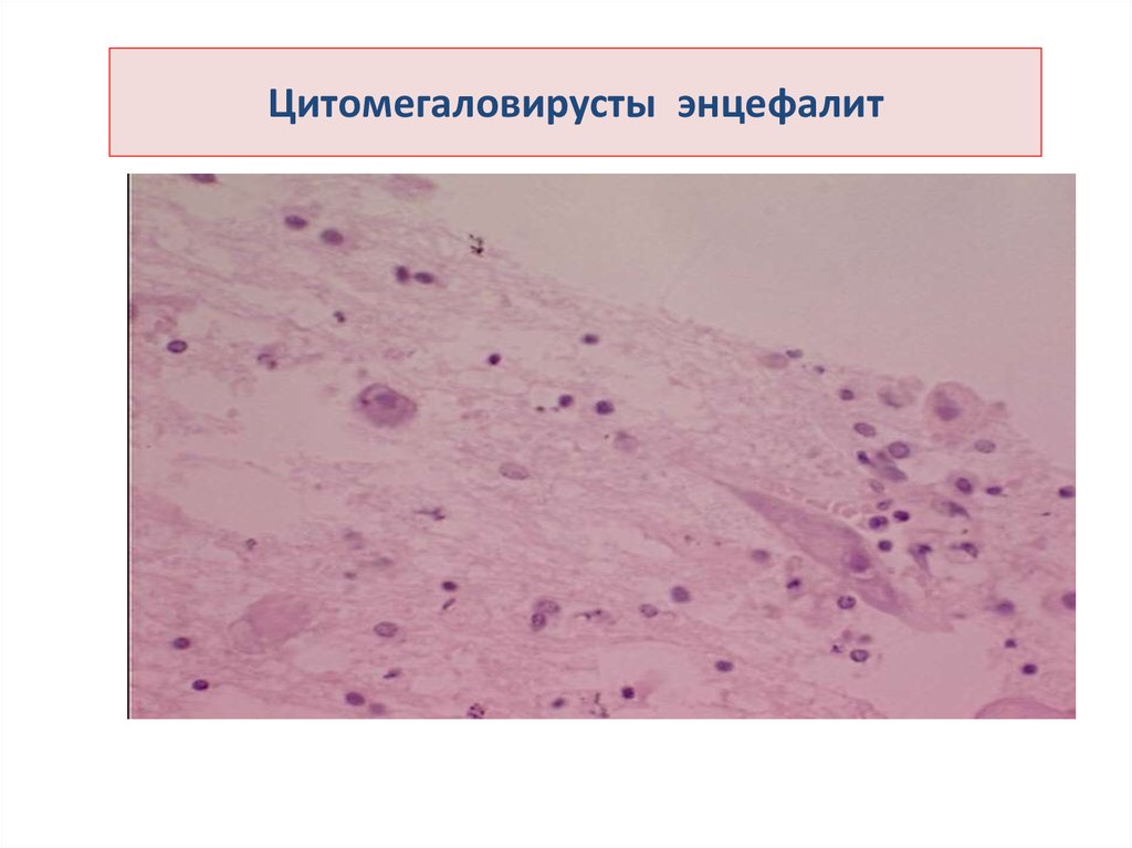 Герпетический энцефалит. Продуктивный энцефалит. Продуктивный энцефалит микропрепарат. Энцефалит микропрепарат.