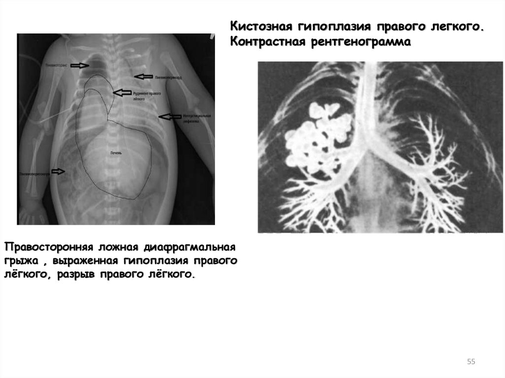 Гипоплазия легкого презентация