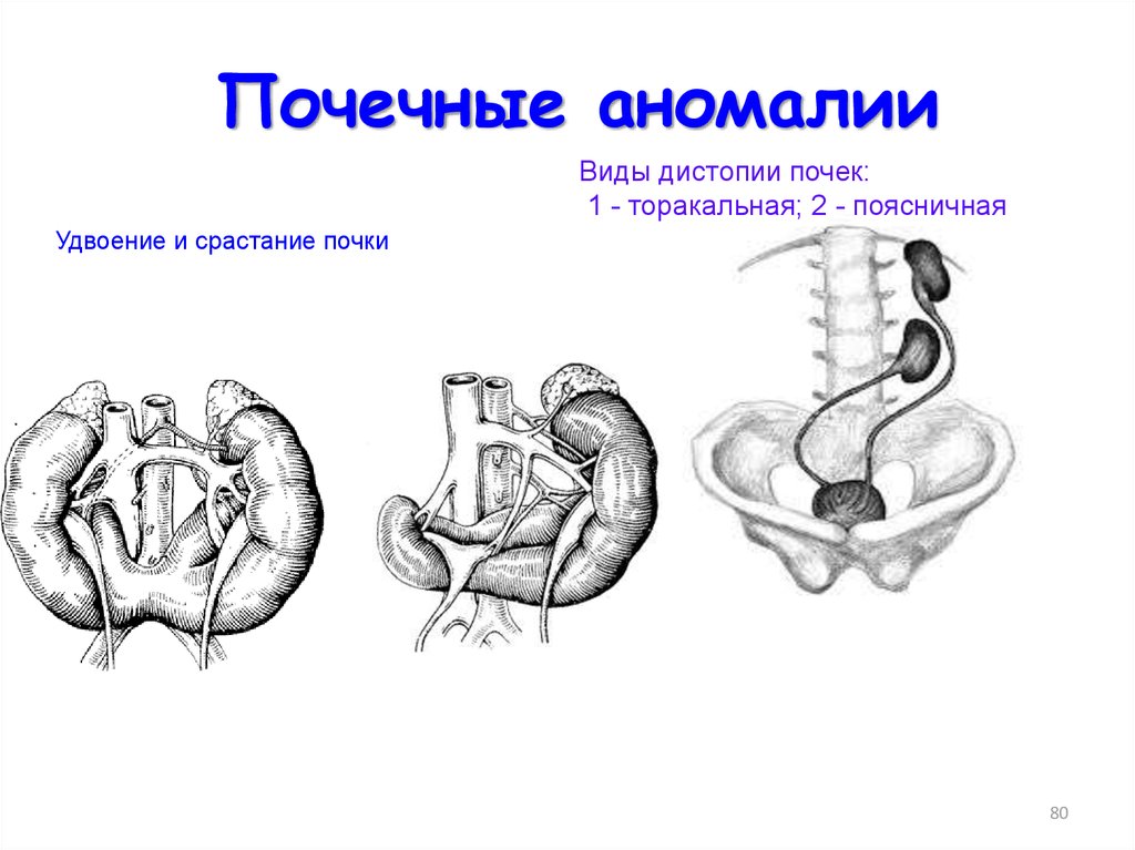 Аномалии почек презентация