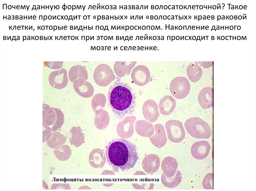 Селезенка лимфоциты. Волосатоклеточный лимфоциты. Волосатоклеточный лейкоз клетки. Волосатоклеточный лейкоз кровь. Волосатоклеточный лейкоз костный мозг.