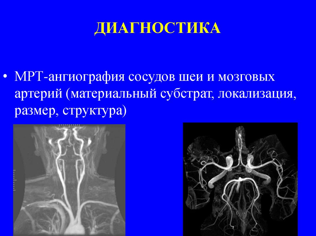 Ангиография сосудов головного