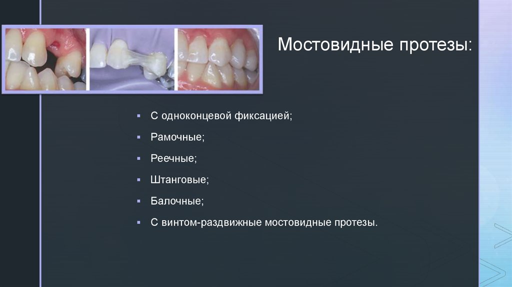 Зубное протезирование в детском возрасте презентация