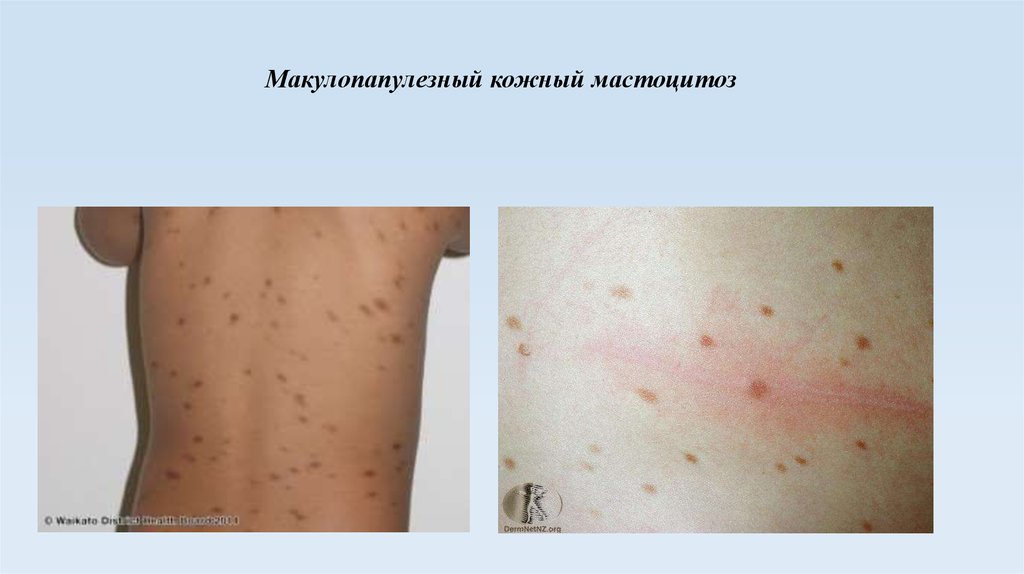 Макулопапулезный кожный мастоцитоз