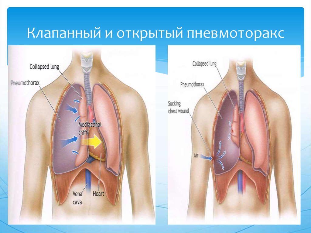 Клапанный пневмоторакс презентация