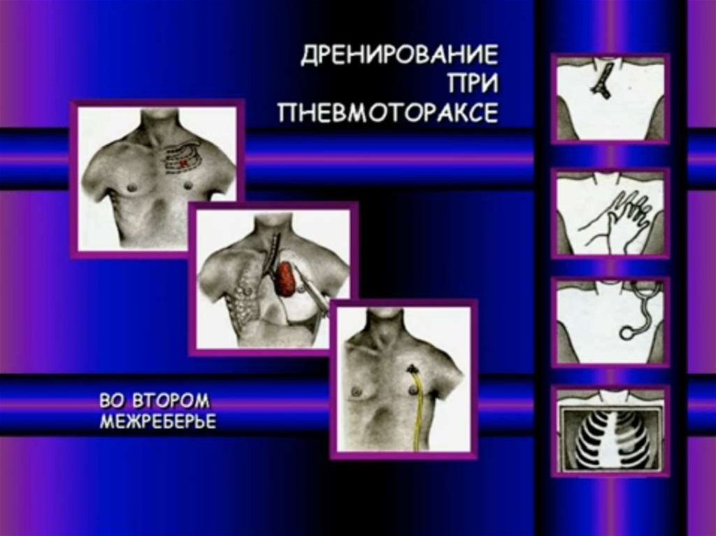 Презентация на тему травмы грудной клетки