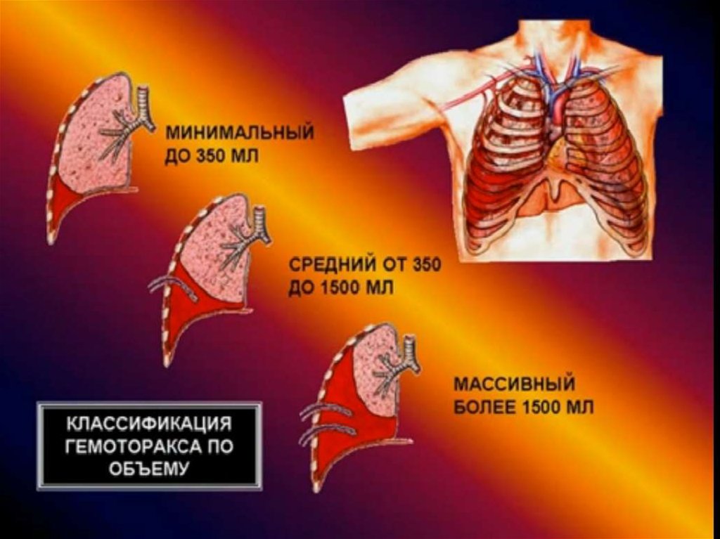 Гемоторакс клиническая картина