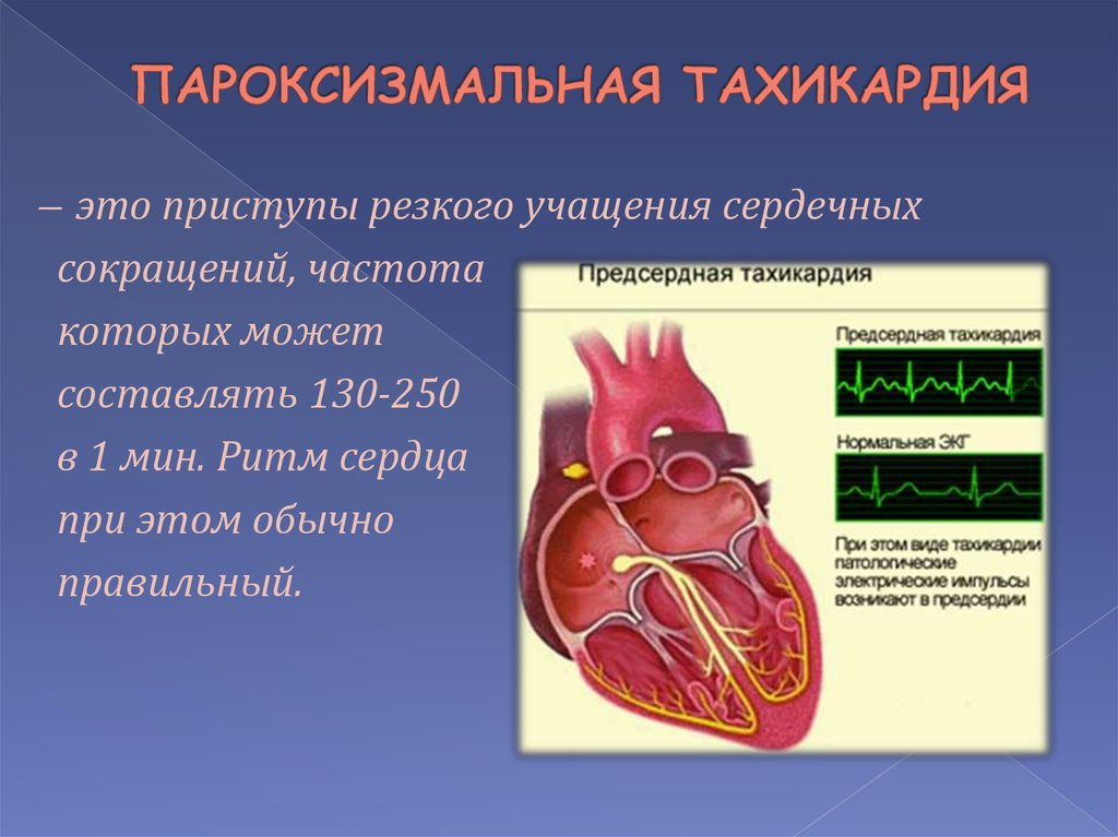 Резко сильное сердцебиение. Тахикардия. Приступ тахикардии. Приступ пароксизмальной тахикардии. Сердечные заболевания тахикардия.