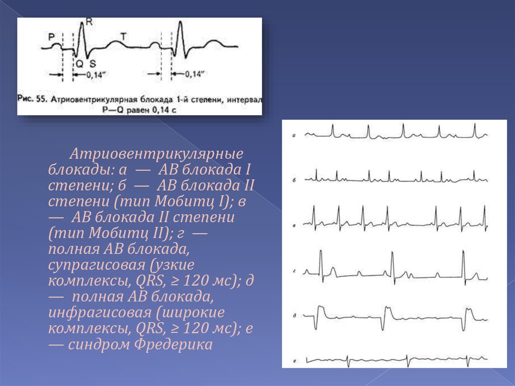 Блокада сердца. Интервал PQ при АВ блокаде 1 степени. АВ блокада 1 степени аускультация. ЧСС при АВ блокаде. АВ блокада 2 ЧСС.