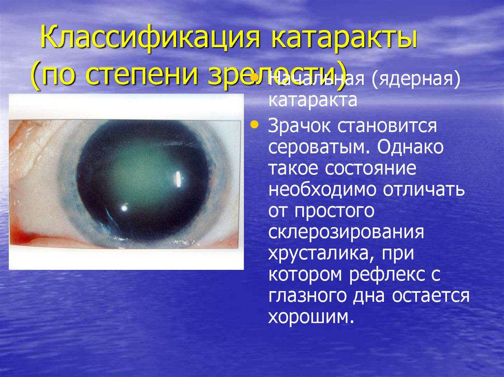 Катаракта глаза лучшие хрусталики. Переднекапсулярная катаракта. Классификация катаракты по степени зрелости. Катаракта глаза глазное дно. Начальная ядерная катаракта.