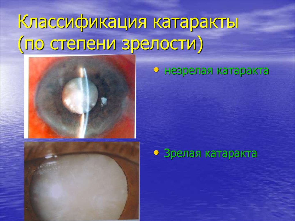 Презентация по офтальмологии катаракта