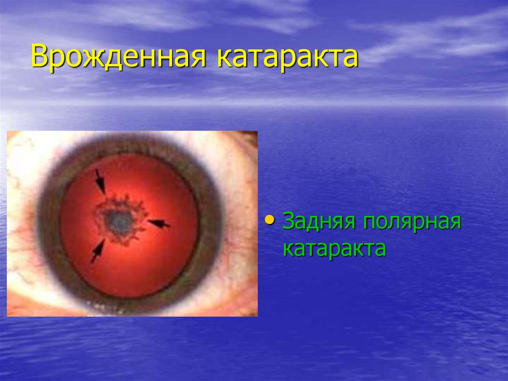 Врожденная катаракта. Врожденная заднеполярная катаракта. Врожденная Полярная катаракта. Задняя Полярная катаракта. Задняя Полярная врожденная катаракта.