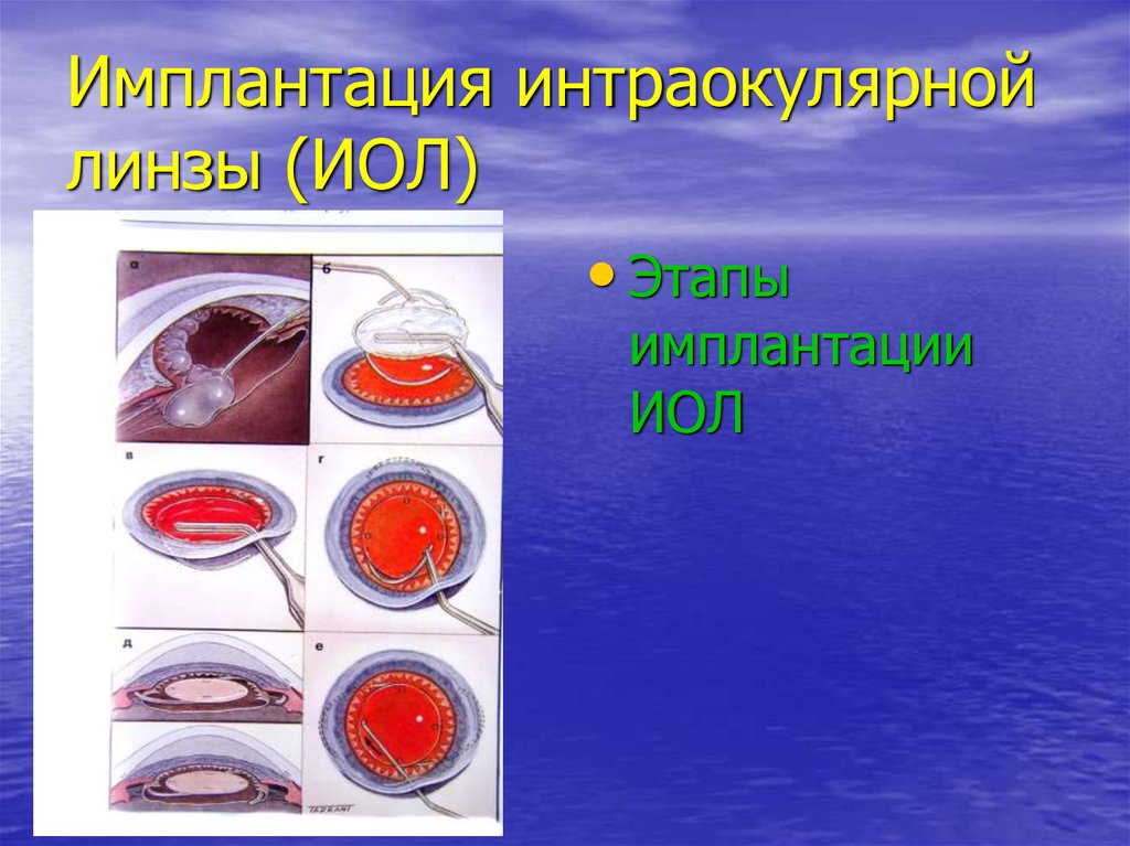 Интраокулярные линзы презентация