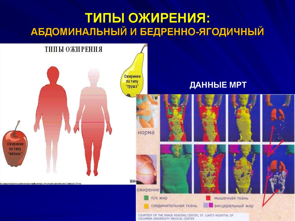 Виды ожирения живота. Типы ожирения. Абдоминальный Тип ожирения. Ожирение типы ожирения. Центральный (абдоминальный) Тип ожирения.