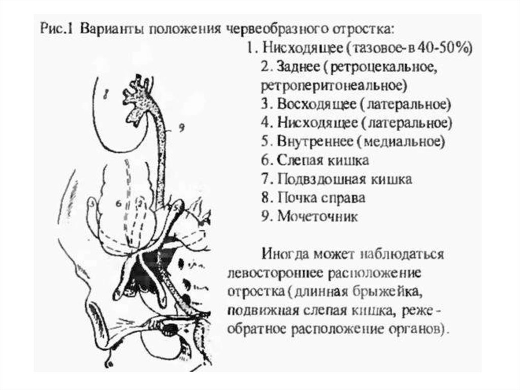 Варианты аппендикса. Подпеченочное положение червеобразного отростка. Ретроцекальное ретроперитонеальное расположение аппендикса. Атипичное расположение аппендикулярного отростка. Нисходящее положение червеобразного отростка.