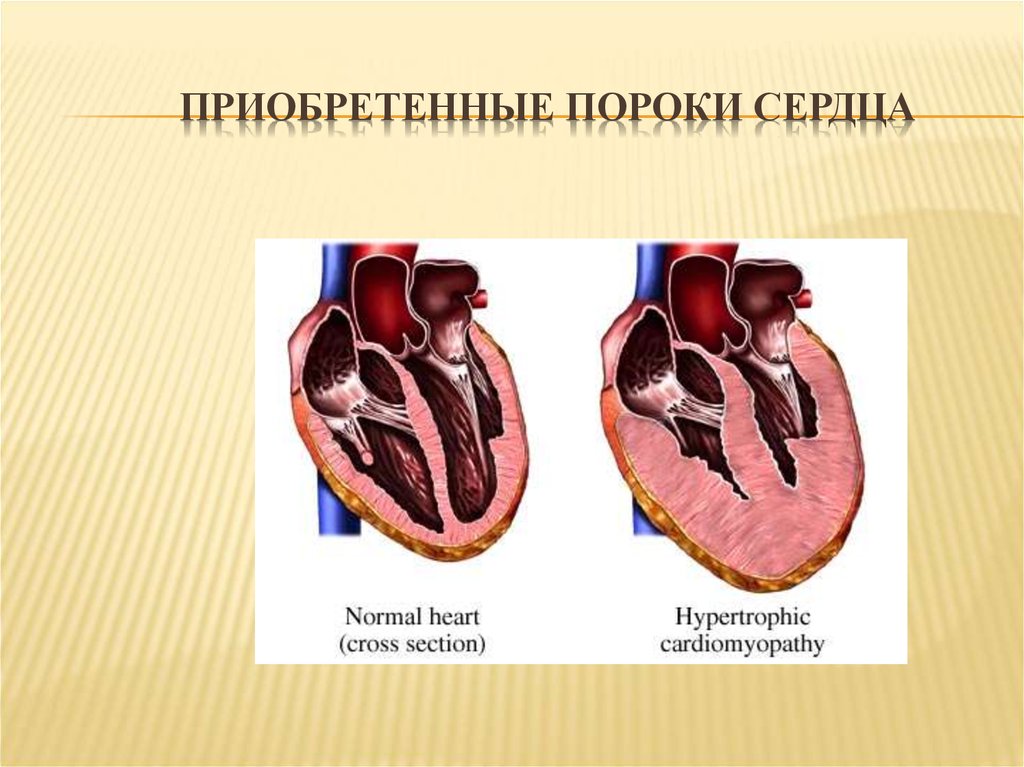 Порог сердца что это. Приобретенные пороки сердца патологическая анатомия. Приобретенные клапанные пороки сердца. Приобретенные пороки сердца топографическая анатомия. Прок сердца преобратонный.
