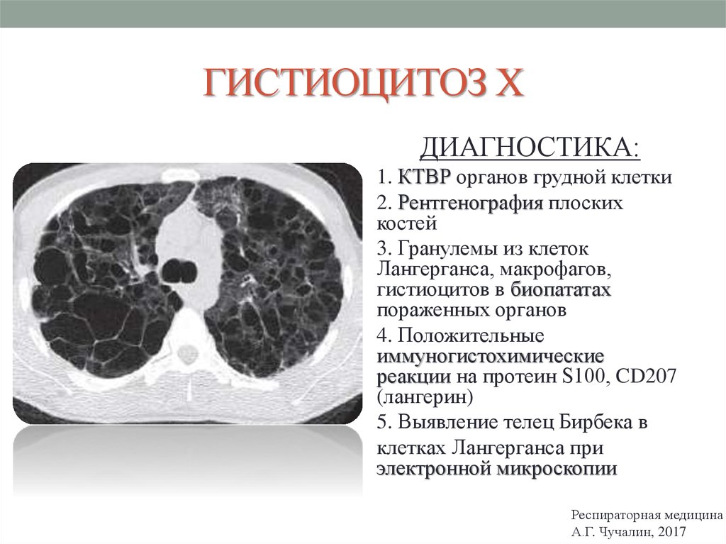 Гистиоцитоз х презентация