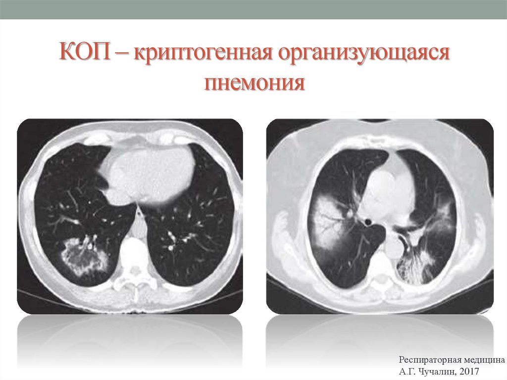 Лекарственные поражения легких презентация