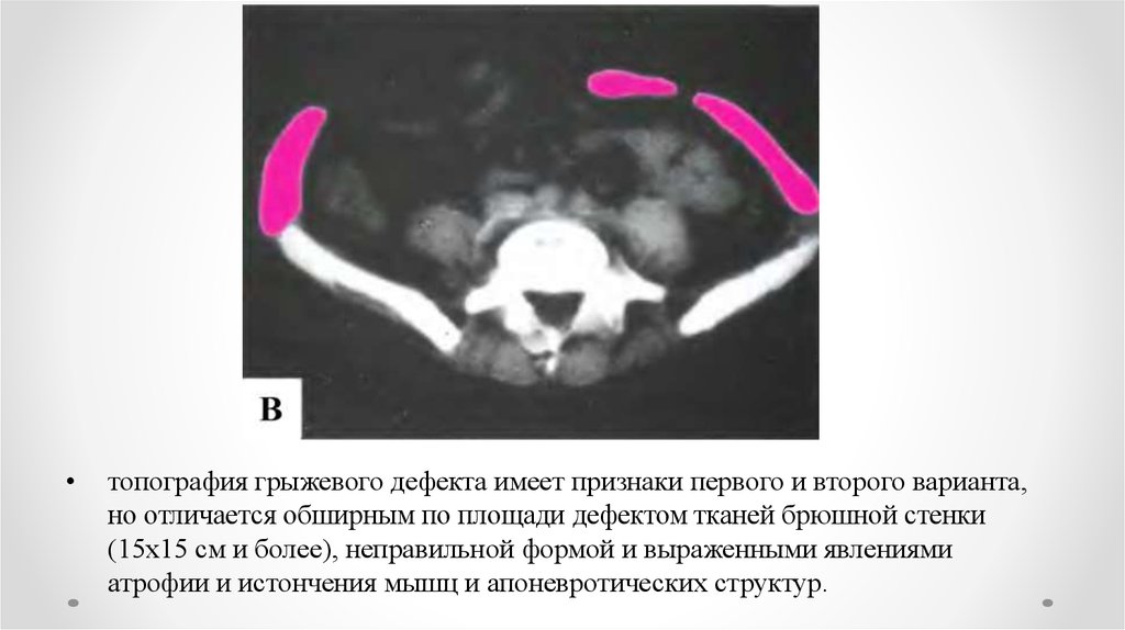 Вентральный это. Вентральная грыжа кт описание.